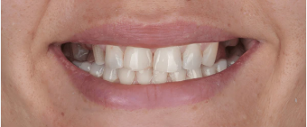 Smile Makeover Before
